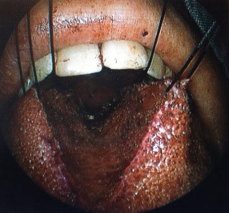 1224 S G MACKAY, N JEFFERSON, L GRUNDY et al. FIG. 3 Peri-operative view showing sutures used to mobilise tongue during posterior excision. segment of tongue tissue.