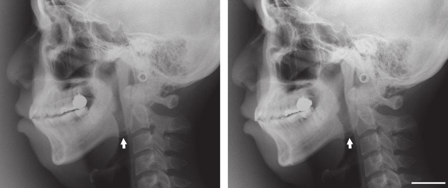Correspondence 117 Fig. 3. Lateral cephalometric radiography before and at 6 months after transsubmental tongue-base suspension.