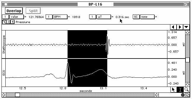 Lesson 16: Blood Pressure Page 27 7. Select the point that corresponds to the end of the Korotkoff sounds (diastolic pressure) as recorded by the stethoscope (Fig. 16.19).