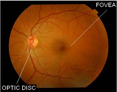 (d) Figure 1: Retinal images. High quality with typical background disc colour, high quality but pale disc, poor quality due to blurring, (d) poor quality due to exposure problems.