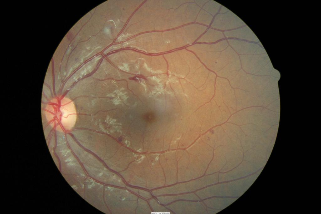 Conversely, if the image is of insufficient quality, such as those shown in Figure 1 and Figure 1(d), blood vessel detection near the fovea is difficult due to blurring and other exposure problems.