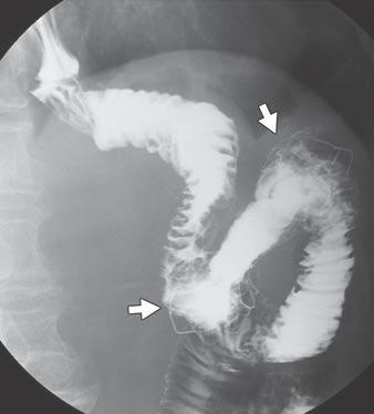 jejunal obstruction extending to the anastomotic site or esophagus, and peritoneal seeding with multiple small-bowel obstructions. The diagnosis of Fig. 1 Two types of stents used in this study.