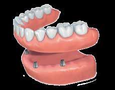 » There are various possibilities for prosthetic restorations «5 Paste the titanium base into the denture to create a