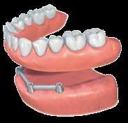 inserted in the denture on the model and / or in the mouth.