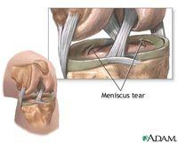 Two wedge-shaped pieces of meniscal cartilage act as "shock absorbers" between your