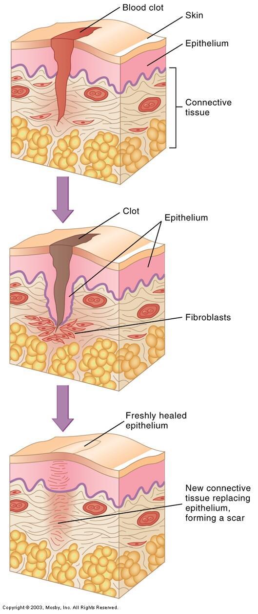 Steps of Tissue Repair 1. capillaries dilate brings blood to supply clotting factors 2. clot forms seal off injury 3. scab forms protect injury 4.