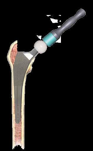 Stem Driver Implant Insertion The selected TaperSet Femoral component, standard or RDP is attached to the Stem Driver, threading it to the stem.