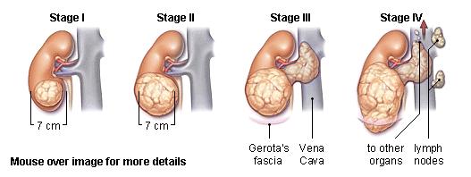 Renal Cancer Surgically resectable