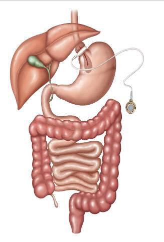 Question 7: Which of the above is known as the Roux, gastric bypass, or Roux-en-Y gastric bypass?
