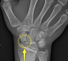 -most common carpal fracture -FOOSH injury -if untreated will improve, then worsen -variable