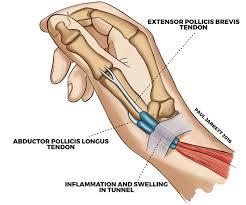 especially nondisplaced fractures -thumb spica brace and repeat x-rays in 1-2 weeks 1.