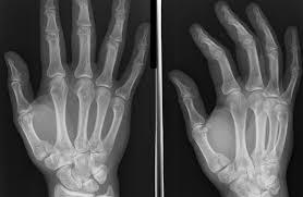 Bennetts Fracture -intraarticular fracture-dislocation of 1 st metacarpal at CMC joint 1.