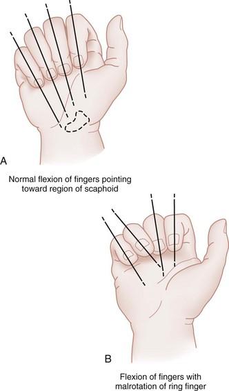 oblique and spiral fractures higher risk malrotation -always assess for malrotation by asking to make a fist 1. all fingers point to scaphoid 2.