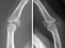 3. < 6 mm shortening -if unsure, use radial or ulnar gutter splint Distal Phalanx Fractures -stable fractures -pay attention to nail bed 1.