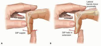 extensor mechanism over PIP joint -injury = difficulty or inability to extend PIP joint -Causes: 1.