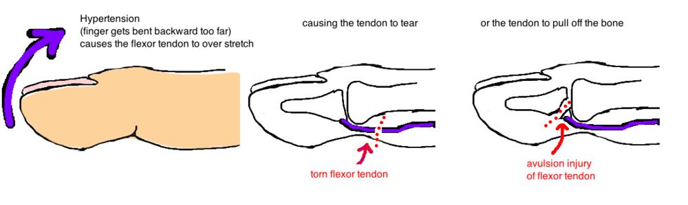 +/- avulsion fracture -forceful hyperextension of DIP joint 1. football and rugby players grabbing jerseys 2.