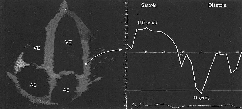 Silva et al Arq Bras Cardiol Systole Diastole RV LV RA Fig.