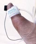 Toe Pressures and TBIs Uses a photo phlethysmograph (ppg) sensor to detect pulsatile perfusion of the toe A small cuff on
