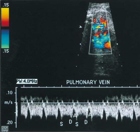 Totally Anomalous Pulmonary Venous Connection were connected to the left atrium or to the pulmonary venous confluence behind the left atrium.