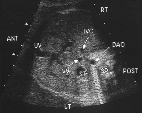 Patel et al Figure 2. A, Fetus with right isomerism: 4-chamber view shows dextrocardia with a common atrium and single ventricle.