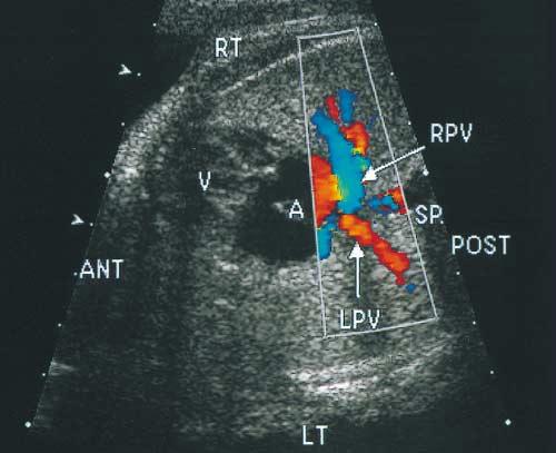 B, Cross-sectional view at the level of the abdomen shows the stomach on the left, a midline liver, and right juxtaposition of the inferior vena
