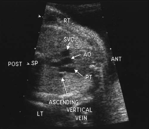 Note that the pulmonary veins are not communicating with the left atrium.