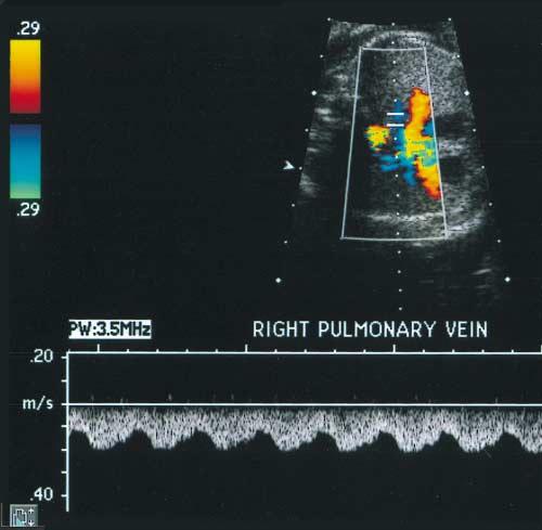 C, The 3- vessel view at the level of great arteries shows the ascending vertical vein to the left of the pulmonary artery.