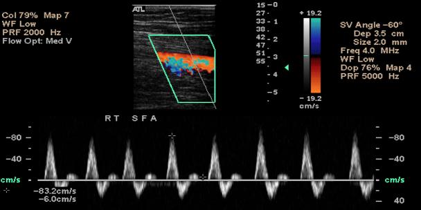 Noninvasive Imaging Tests Duplex Ultrasound Useful to diagnose the anatomic location and degree of stenosis of PAD.