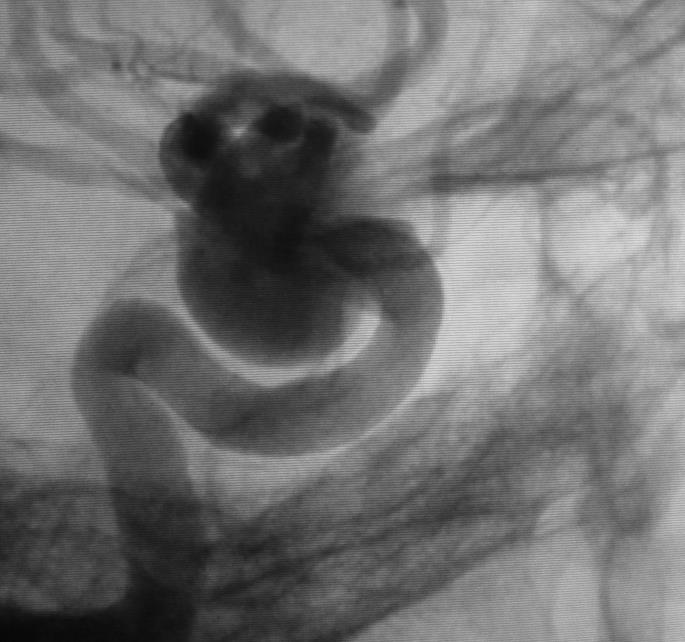Initial Deployment Post Case 1: Giant Sacular ICA Aneurysm - could have been classified as fusiform as