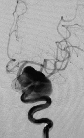 Initial Deployment Post Case 2: Giant Saccular ICA Aneurysm - could have been classified as