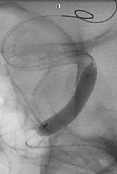 systems Deployment - both stents were accurately placed and opened well (post dilation used to