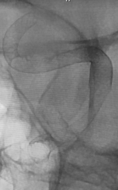 - telescoping may reduce the risk of the first stent prolapsing into fusiform aneurysm