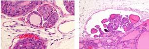 Myc (PPFP) TTF-1 PAX8 (PtenFF;Cre mice have benign thyroid