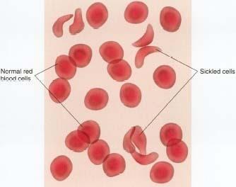 Sickle Cell Anemia: Individuals who are Hh do not have serious health problems and can lead relatively normal lives, but-