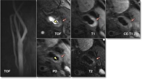 Carotid artery atherosclerotic plaques, stenotic and non-stenotic, cause brain ischemia via artery-to-artery embolism Nonobstructive AHA Type VI Plaque This nonstenosing plaque was detected in a