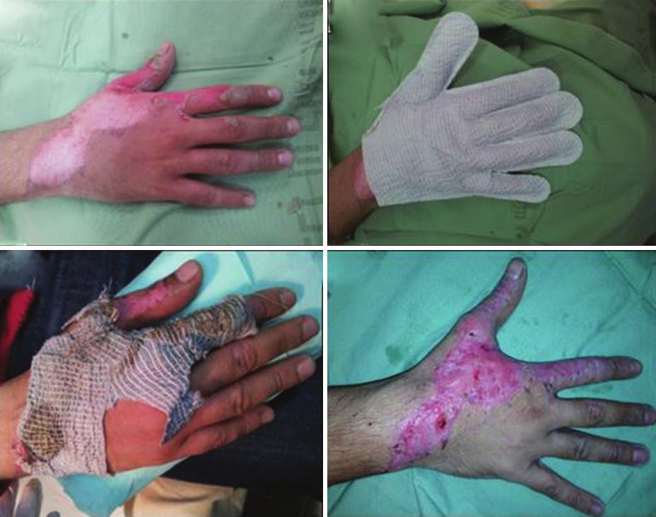 9%; (c) Re-epithelialization day 20; (d) Re-epithelization day 20 Figure 3: Range of movement ability with AQUACEL Ag BURN glove day 7 postapplication b d b d treated with the AQUACEL Ag BURN glove,