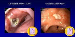 Gastric ulcers tend to develop in the antral region of the stomach, adjacent to the acid-secreting mucosa of the body Pathophysiology o The primary defect is an increased mucosal permeability to