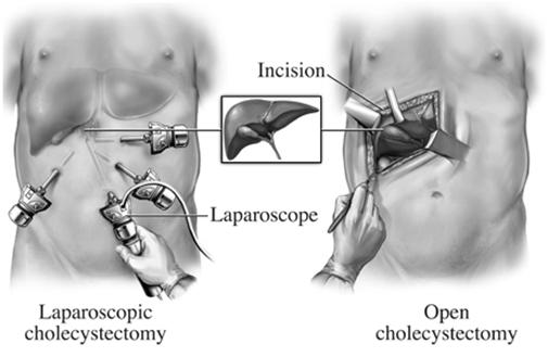 Cholecystectomy Cholecystectomy: Pre-op Nursing Diagnosis Acute pain Alteration in bowel elimination Alteration in comfort Alteration in nutrition Fluid volume deficit Self-care deficit Risk for