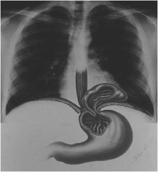Heartburn Belching Regurgitation Paraesophageal Hiatal Hernia Fundus