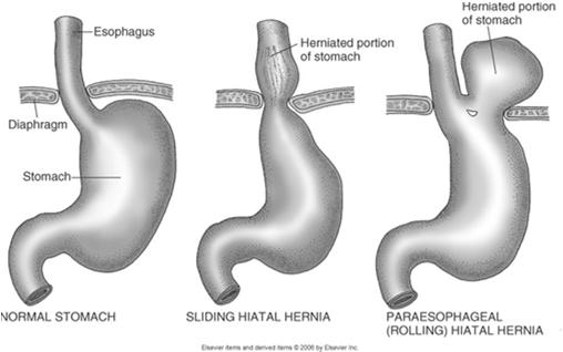 through the esophageal hiatus and into the thorax beside the esophagus