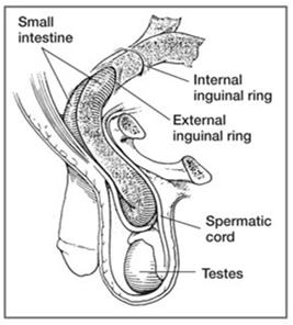 Indirect Inguinal Hernia Peritoneal sac w intestine or omentum pushes down into inguinal canal Affect males May descend into the scrotum S/S: pain with straining Soft