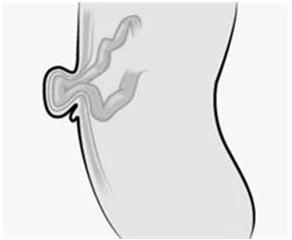 abdominal wall Rarely enters the scrotum Most common in men older than 40; rare in women S/S: usually painless, round swelling close to pubis, which is easily reduced