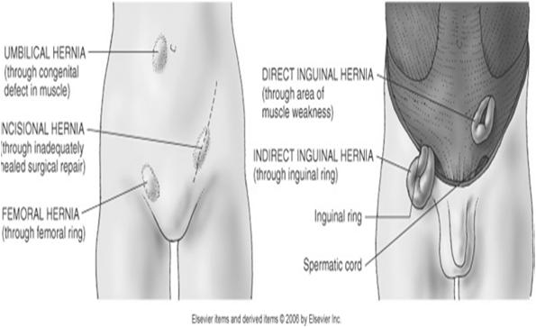Protrude through the femoral ring More common in women than men