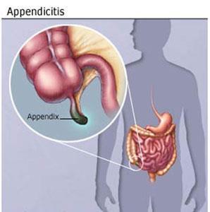 bacteria from appendix can spread to peritoneal cavity.