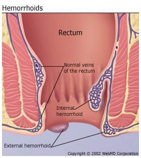 Due to prolonged straining swollen blood vessels of the rectum. Vein walls become stretched thin, and irritated when you have bowel movements.