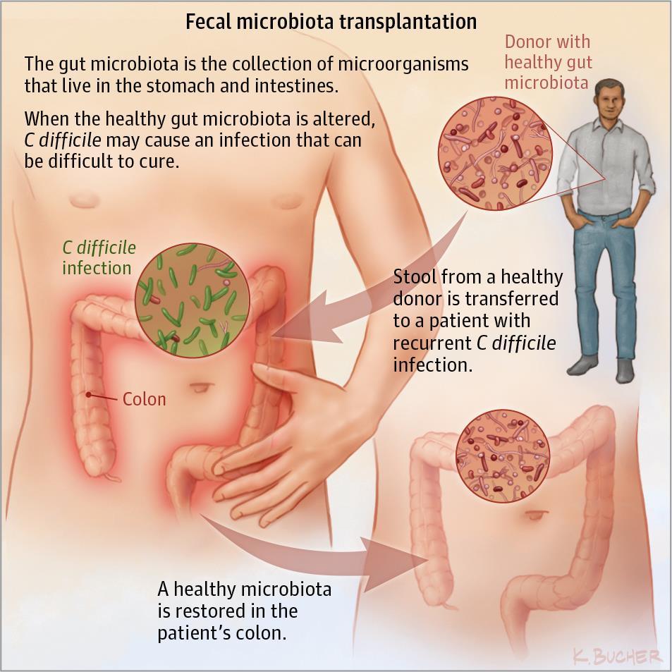 Fecal Transplant for Clostridium Difficile (C. Diff.) Bacteria found all around us.