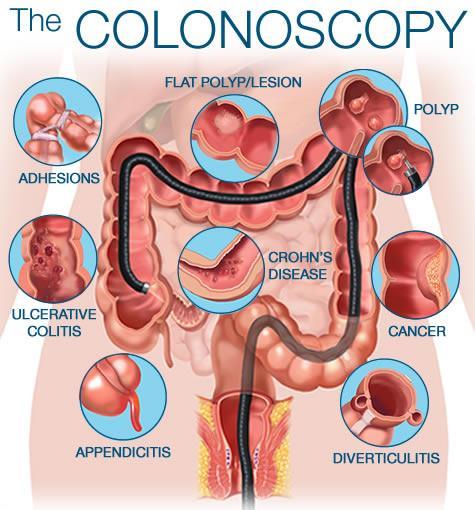 Colonoscopy: a diagnostic and therapeutic procedure.