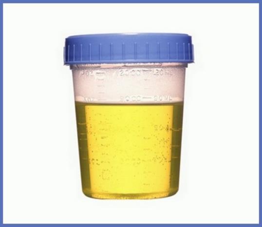 Activity Draw and color the various possibilities of urine samples. (Think specimen cup)!