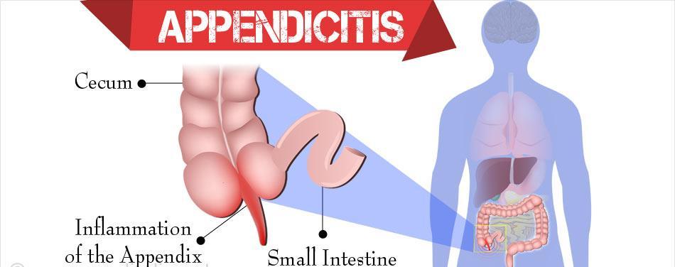 What about the appendix? Appendicitis - for unclear reasons, the appendix often becomes inflamed, infected, and can rupture.
