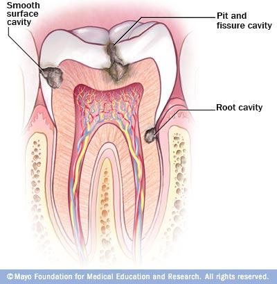 Tooth Decay What do you think causes tooth decay? Saliva is normally slightly alkaline.